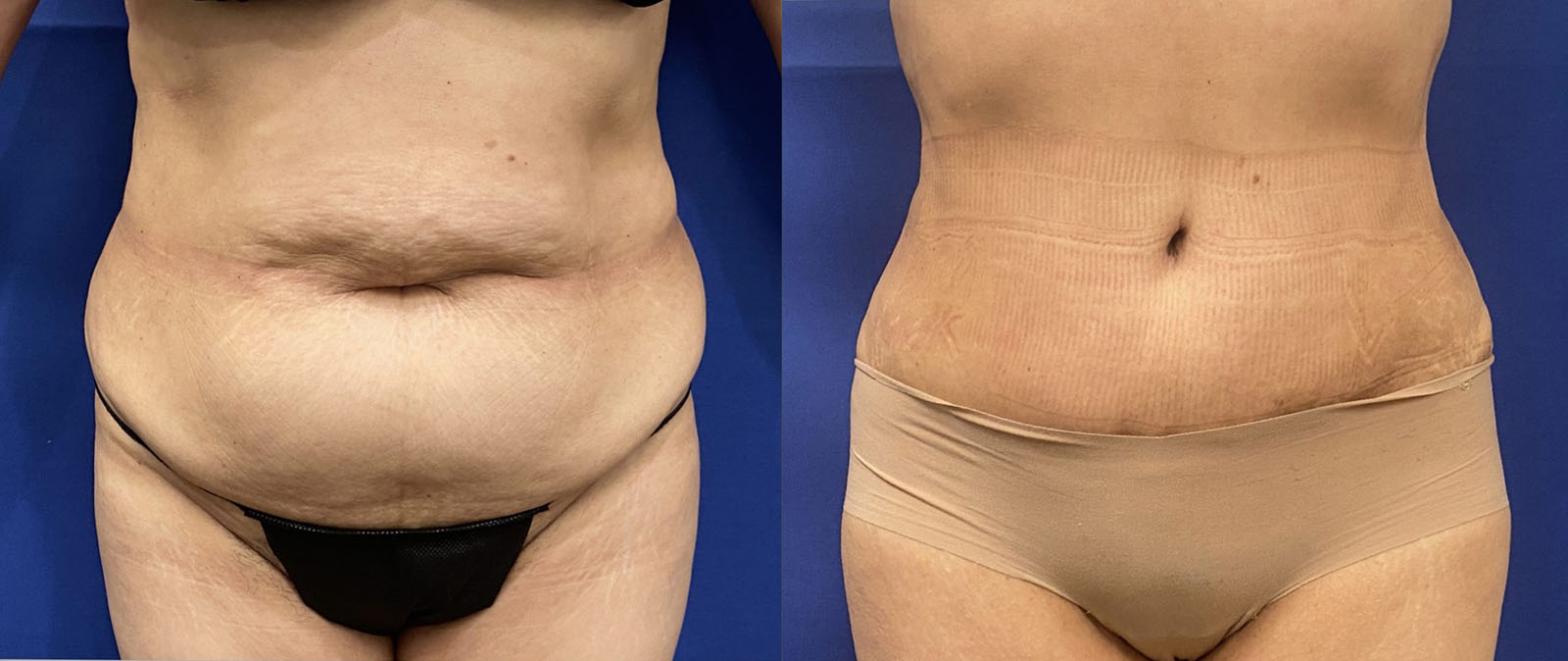 tummy tuck patient