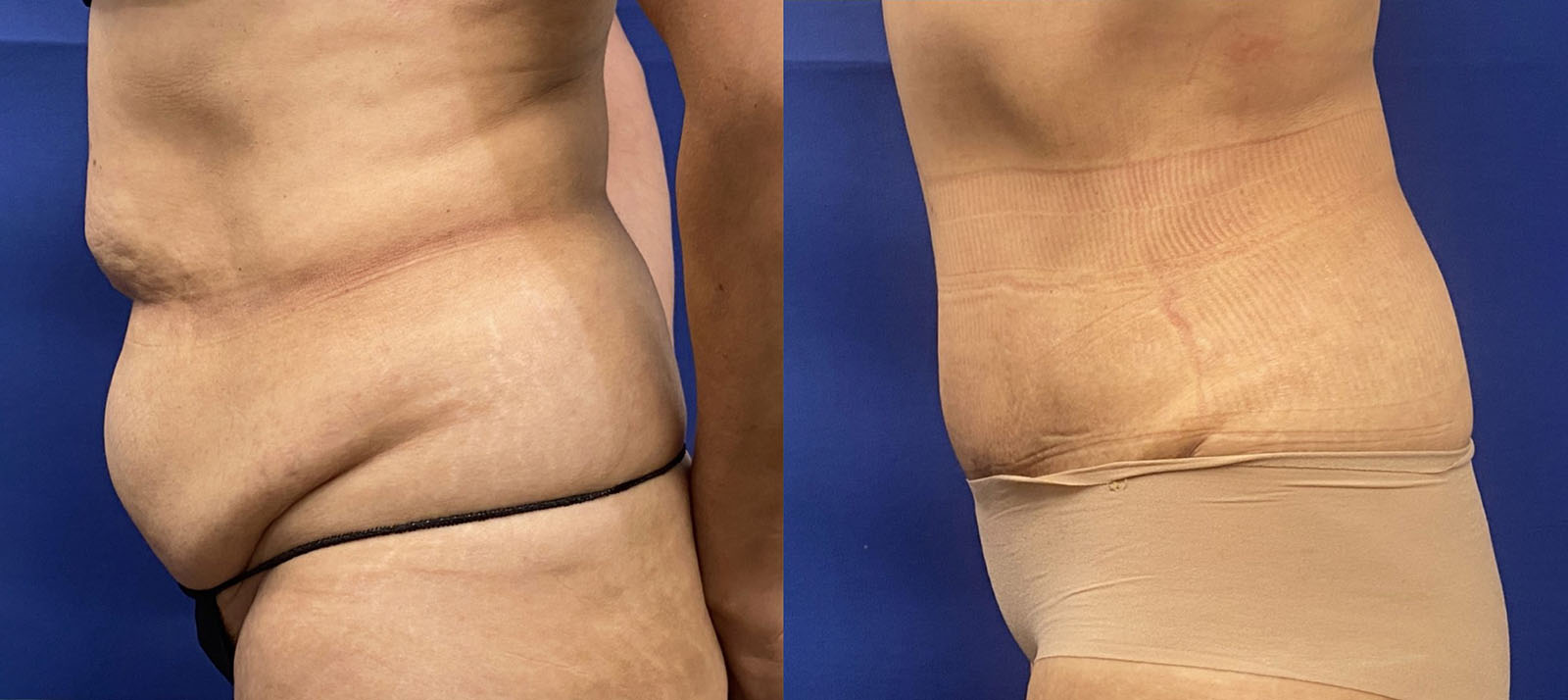 tummy tuck patient