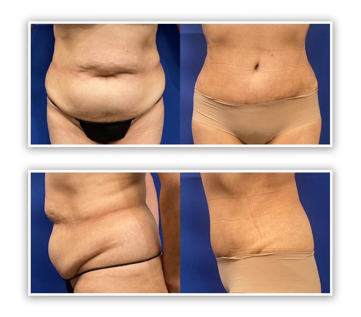 tummy tuck patient