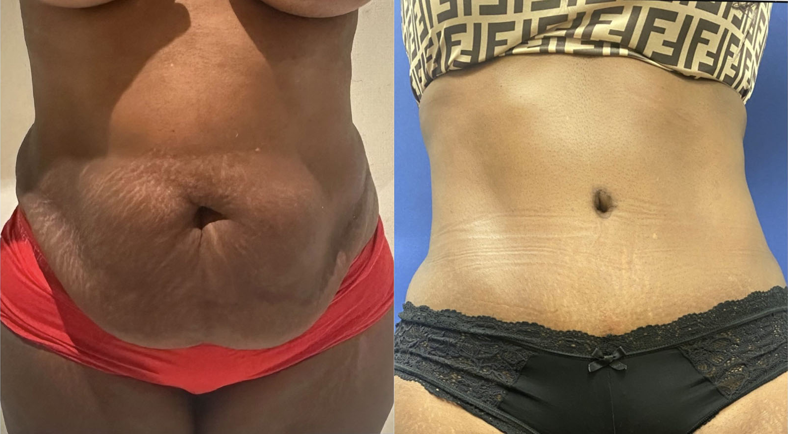 tummy tuck patient