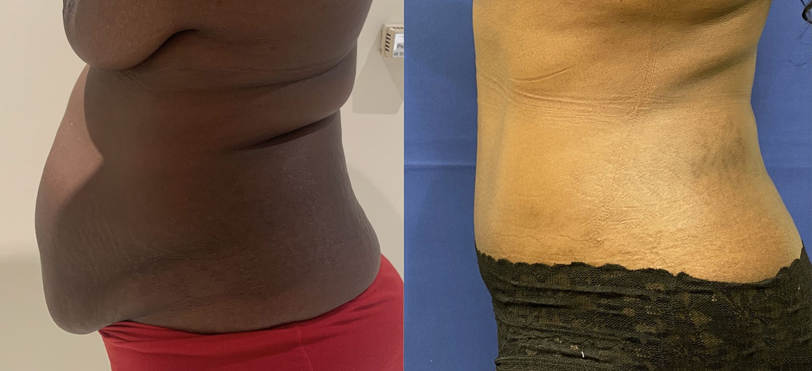 tummy tuck patient