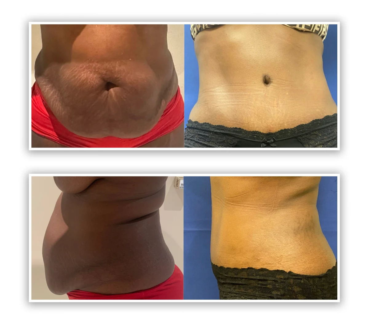tummy tuck patient