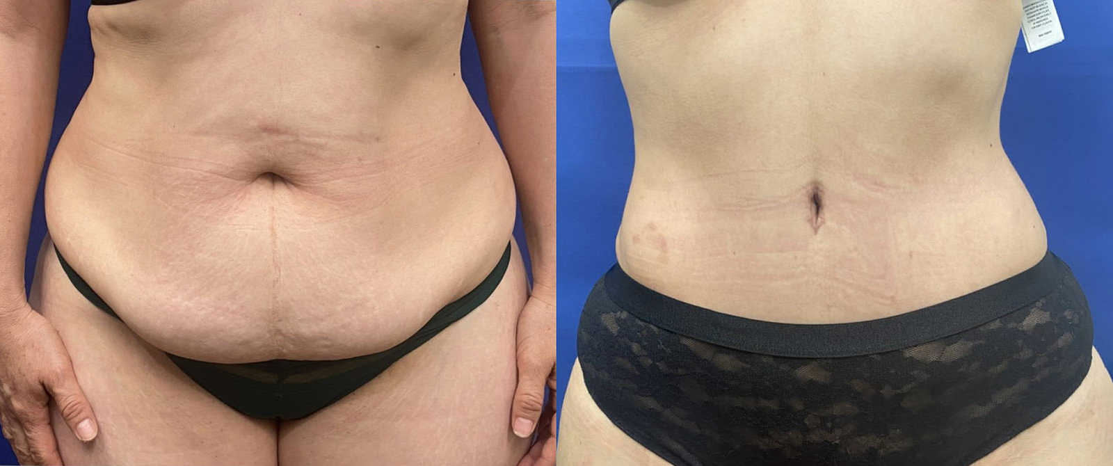 tummy tuck patient