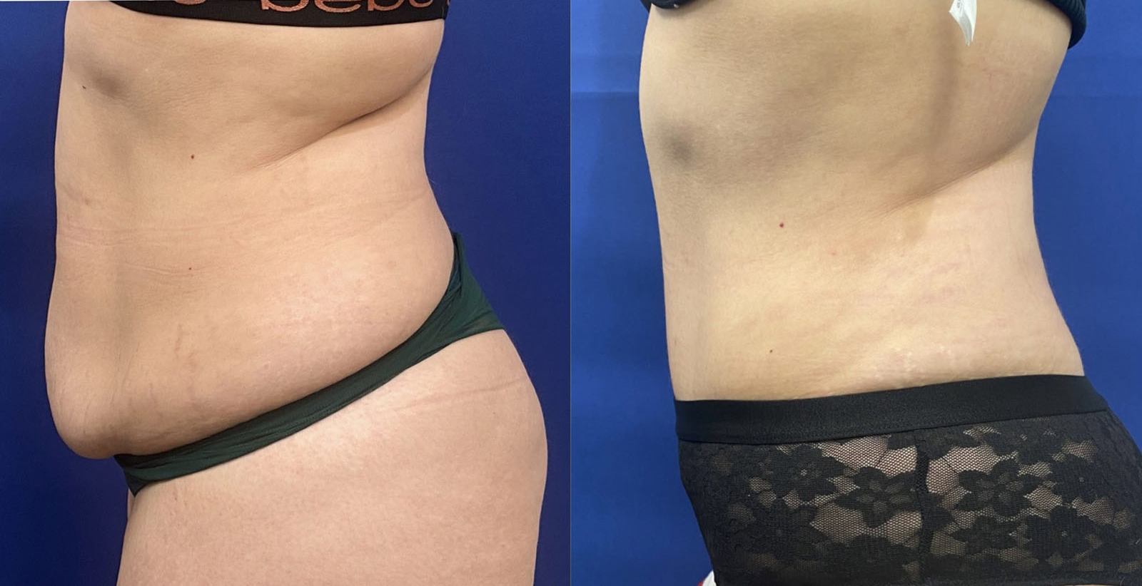tummy tuck patient