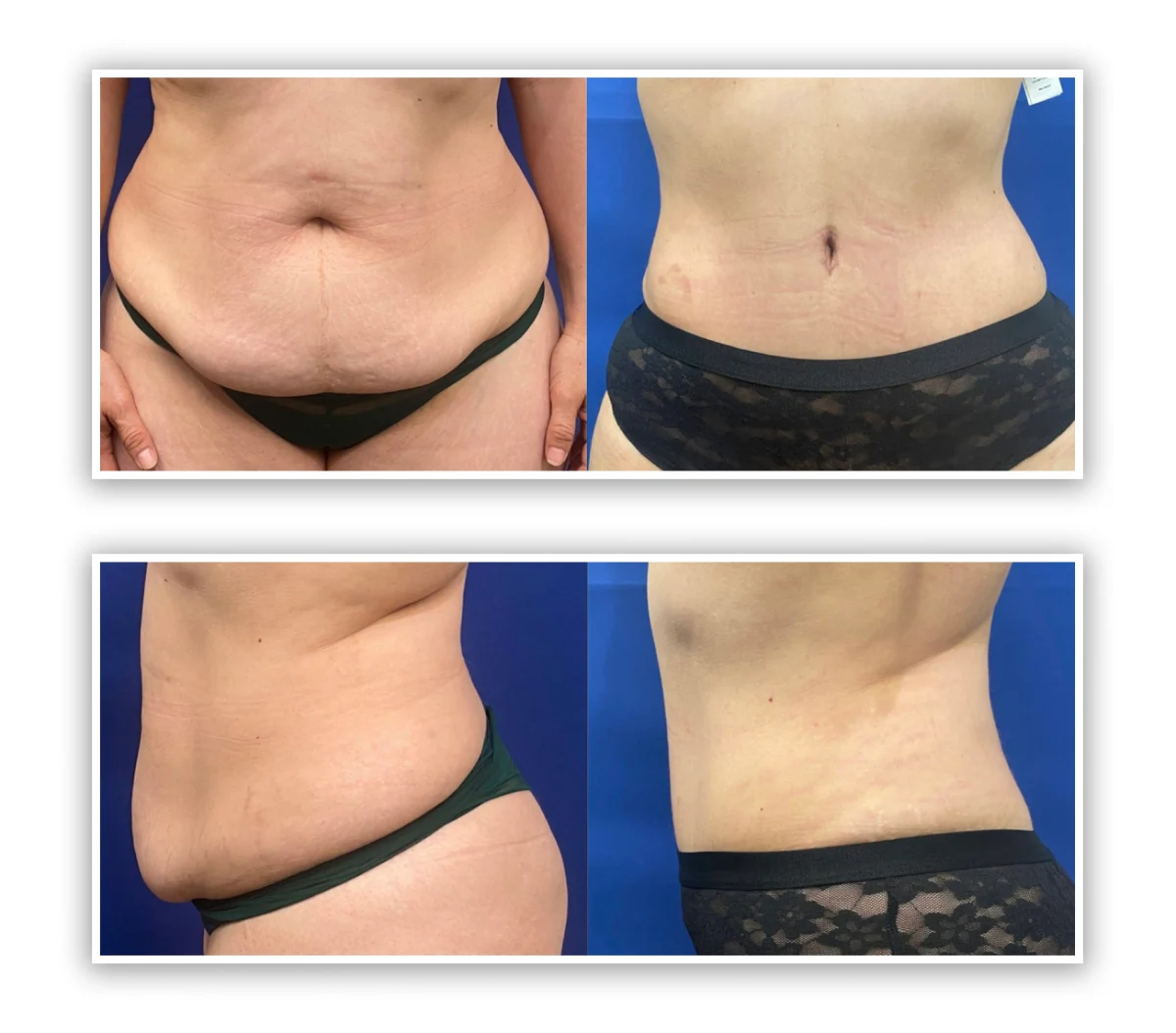 tummy tuck patient